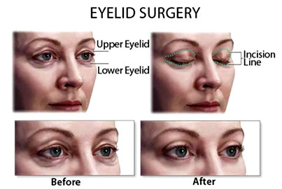 Eyelid Surgery